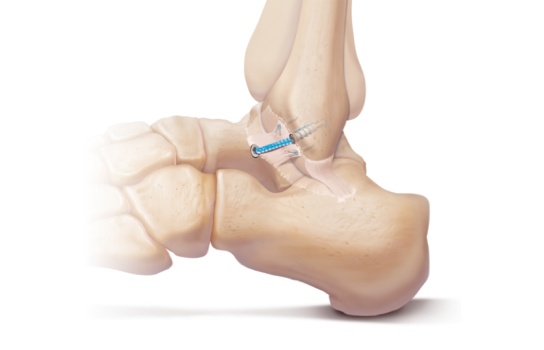 Bristol Ankle Surgery